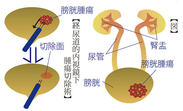 経尿道的内視鏡下腫瘍切除術図